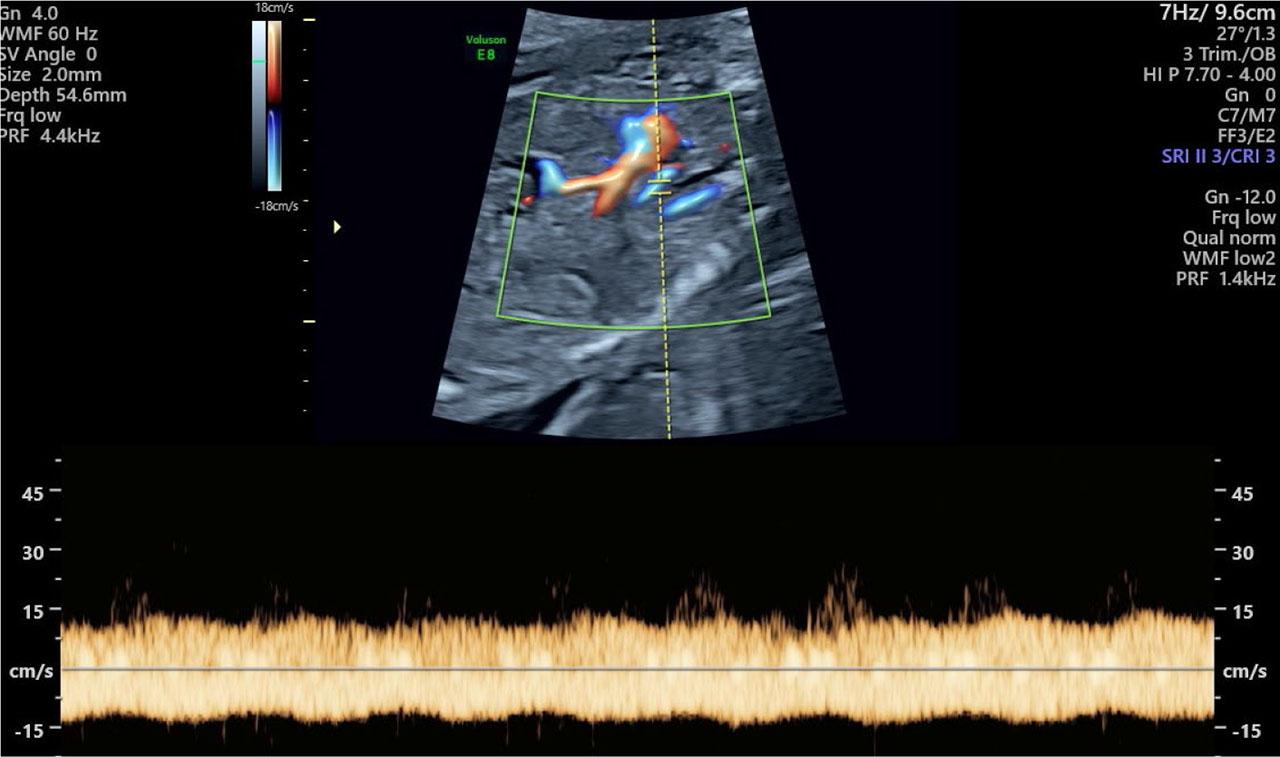 Fetal ultrasound image showing an abnormal vessel with typical venous flow of blood – no increased velocity until the 37th week of pregnancy. Ultrasound image from examination at 21.3 weeks of gestation