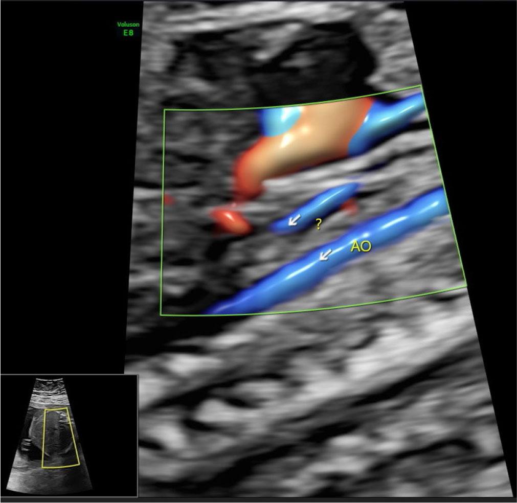 Fetal ultrasound image showing an abnormal vessel. Ultrasound image from examination at 21.3 weeks of gestation
