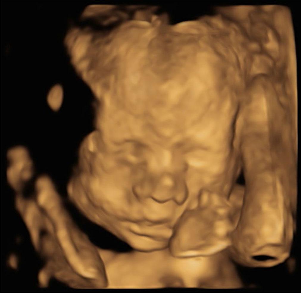 3D representation of the fetus during ultrasound examination at 24.2 weeks of gestation