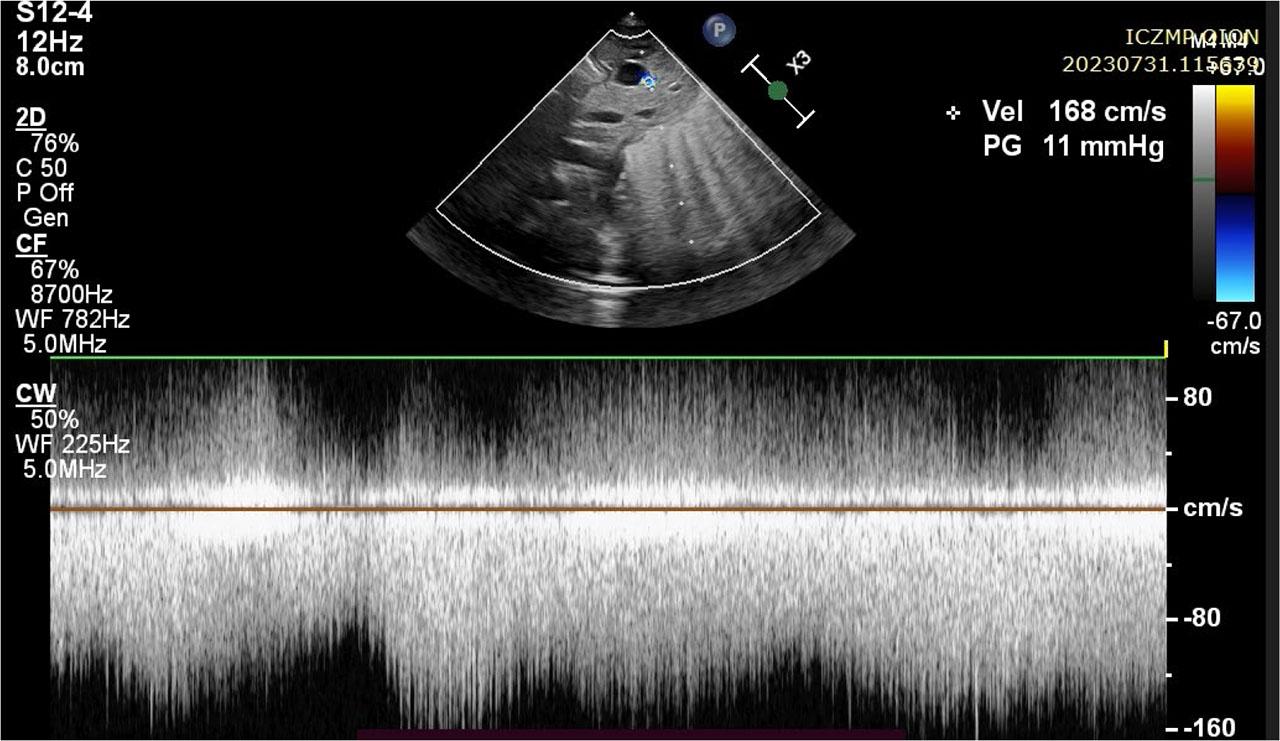 Postnatal ultrasound of a neonate showing a vessel with flow characteristics typical of blood flow restriction