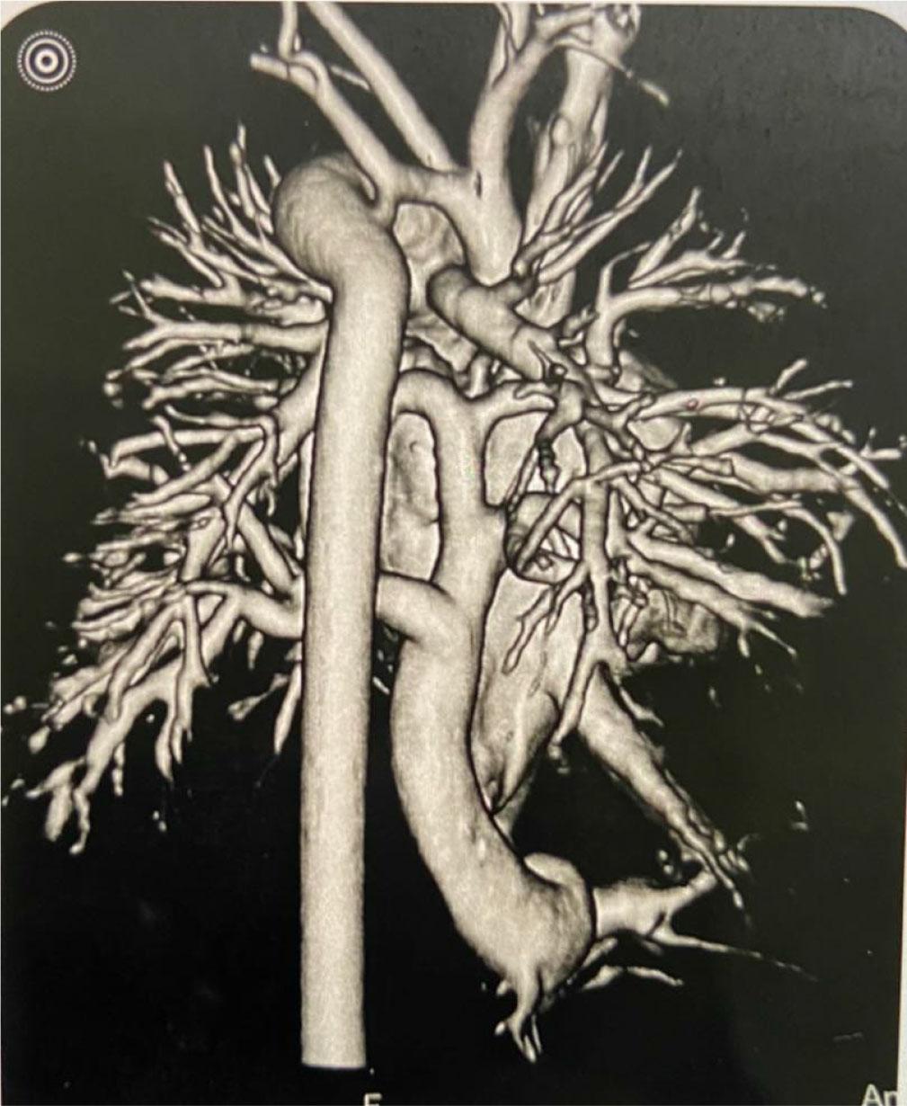 Angio-CT of the heart of a newborn with the collector described in prenatal examination reports