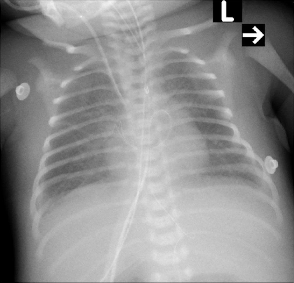 X-ray chest of a neonate on the 1st day of postnatal life showing uniformly aerated lungs with some interstitial densities