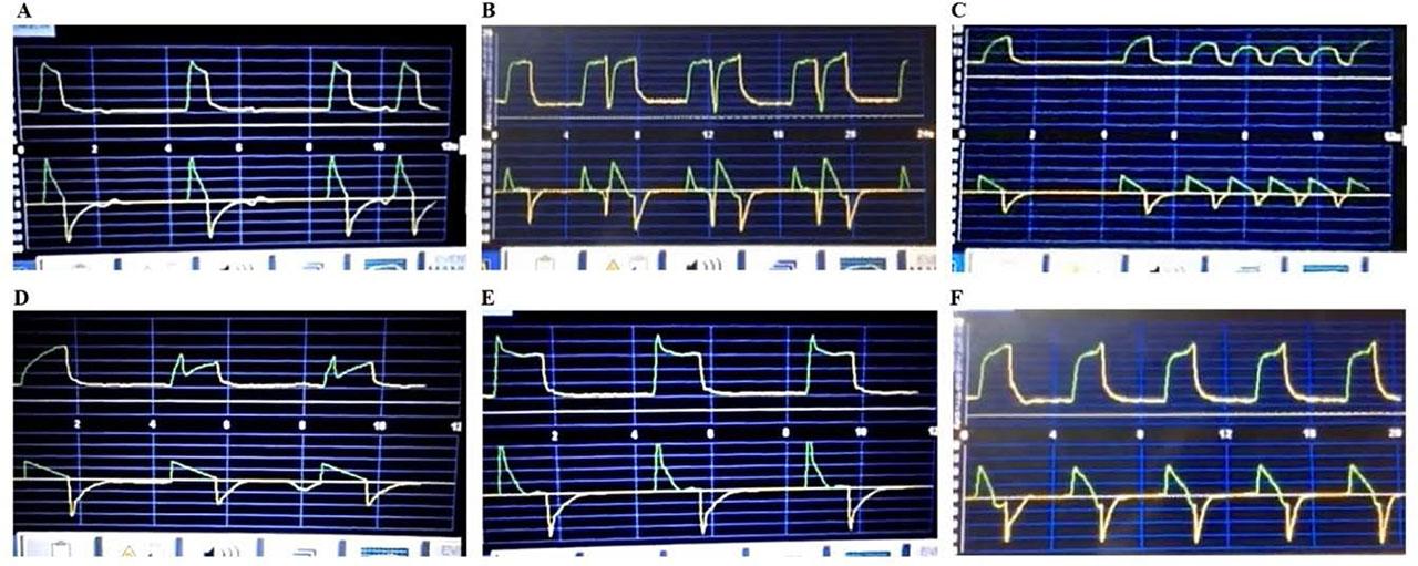 Ventilatory asynchronies evaluated. A: Ineffective triggering; B: Double triggering; C: Auto–triggering; D: Insufficient flow; E: Excessive flow; F: Delayed cycling