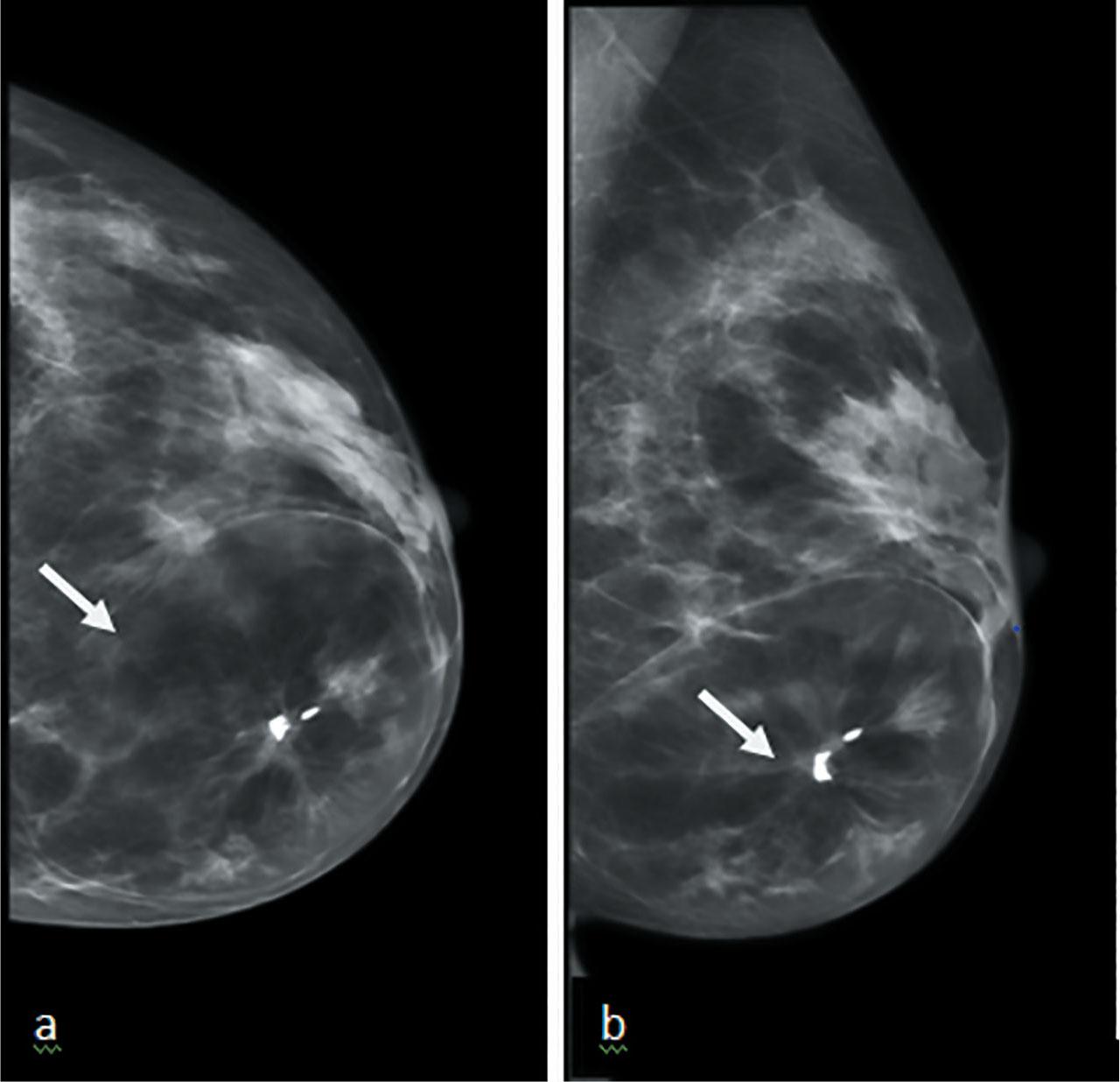 (a) CC and (b) MLO views of hamartoma, seen as encapsulated heterogenous mass in the lower and inner breast with central macrocalifications and distortion (arrows).