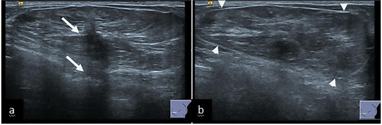 (a) US of hamartoma showing a central small hypoechoic area with associated acoustic shadowing (arrow). (b) The thin echogenic pseudocapsule can also be appreciated (arrowheads).