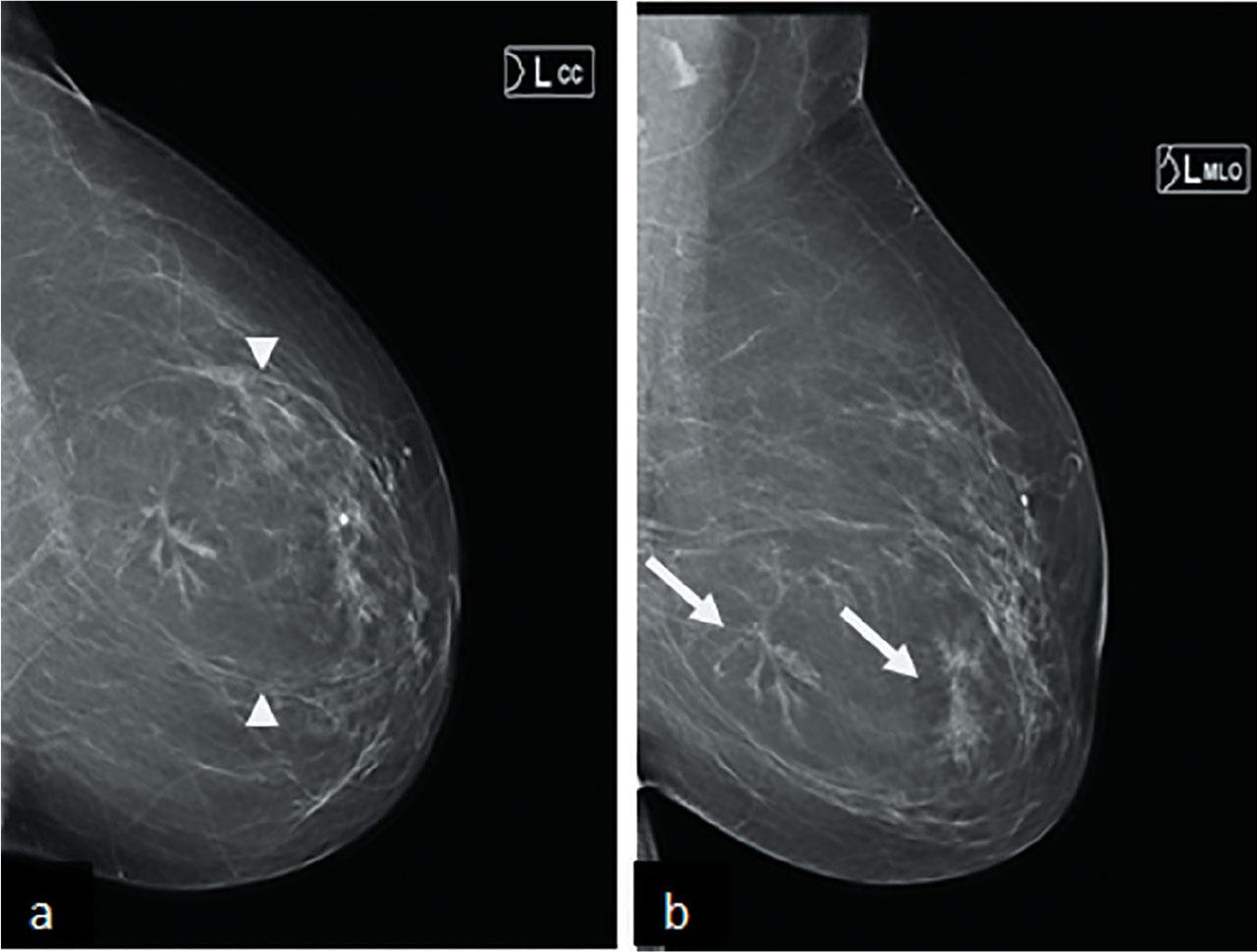 (a) CC and (b) MLO views of mammogram, showing circumscribed mass with pseudocapsule (arrow heads) and central area of distorsion (arrow) in the left lower central breast.