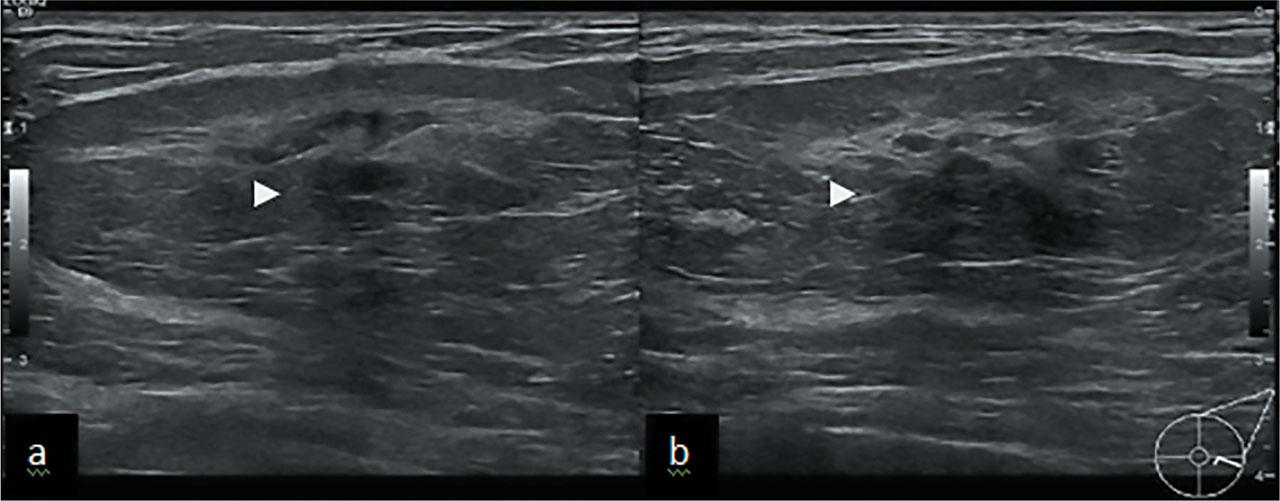 US shows well defined oval mass with central hypoechoic shadowing area (arrowheads) corresponding to mammographic distortion.