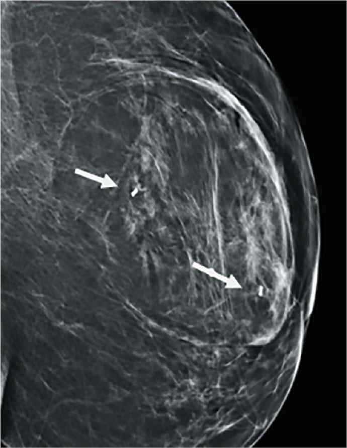 Mammogram showing post VAB marker insertion (arrow).
