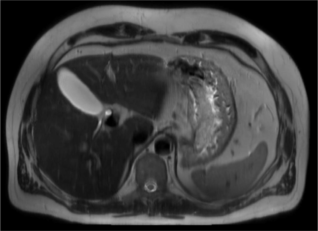 MRI, T2-weighted, axial view – Abdominal cross-sectional T2-weighted MR image demonstrates a large, thickened, edematous gastric wall along the lesser curvature, with preserved rugal folds. This image is atypical for gastric cancer and raises differential diagnoses such as lymphoma, hypertrophic gastritis, or Zollinger-Ellison syndrome.