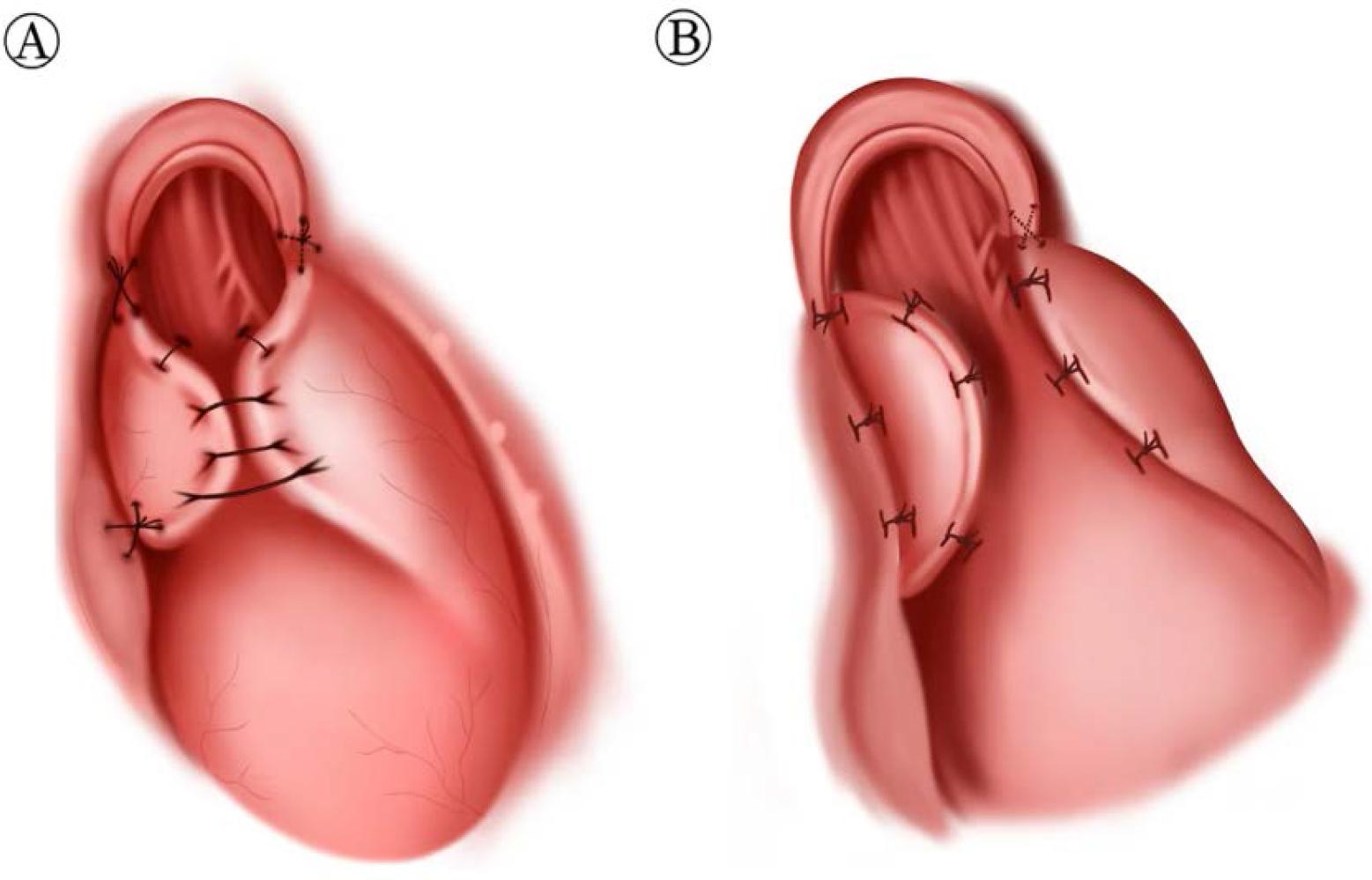 The suture technique and three-point fixation with Nissen fundoplication (A); with Toupet fundoplication (B). Tzortzis N, Eleftheriadis E. Evaluation of the efficacy of partial posterior fundoplication (Toupet) in the treatment of GERD. BMC Surg. 2025;25:124.