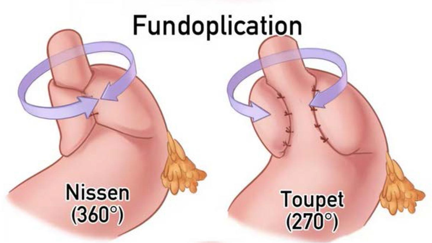 Schematic representation of Nissen (360°) and Toupet (270°) fundoplication techniques. Chen Y, Liu Y, Zhang R, Li X. Long-term outcomes of Toupet fundoplication in GERD patients: a retrospective cohort study. BMC Surg. 2025;25:139.