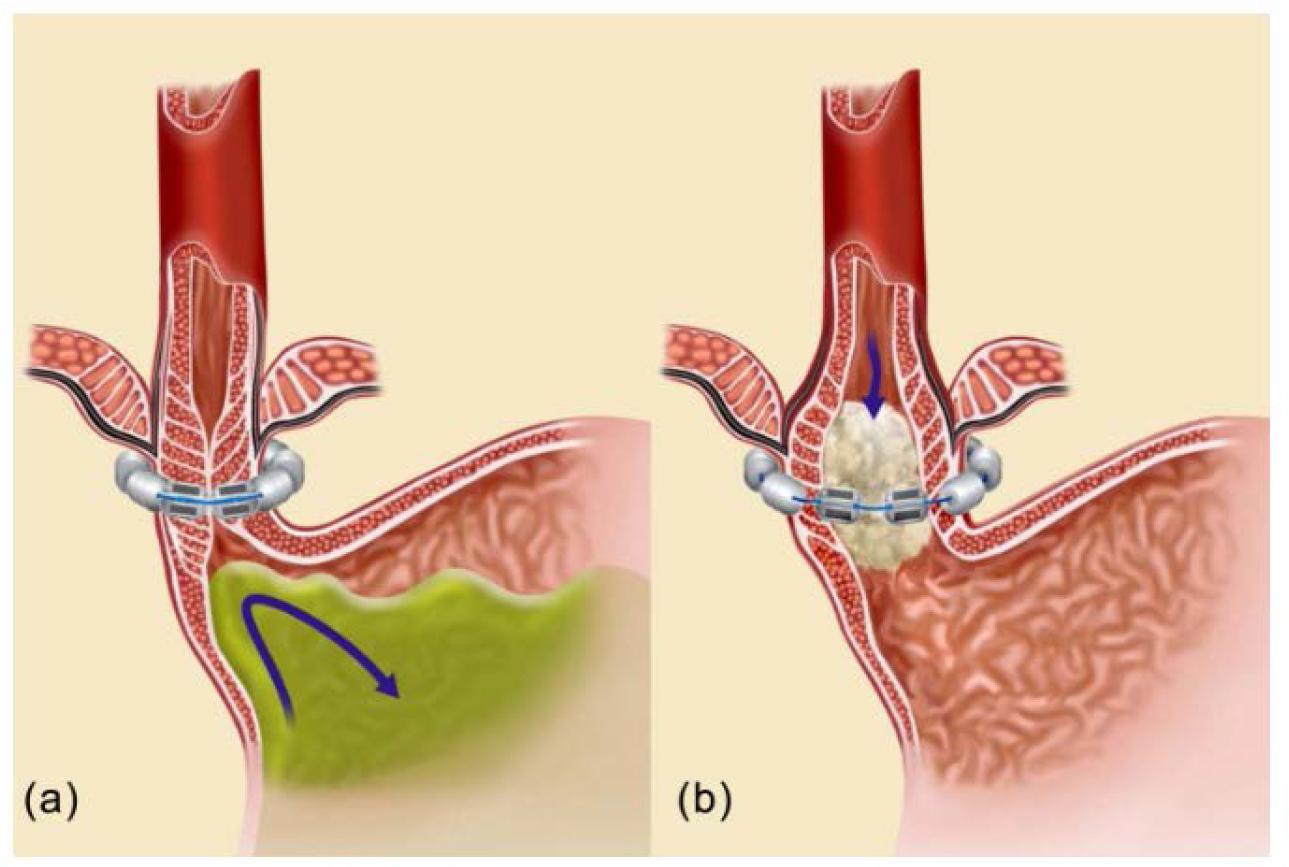 The LINX System encircling the distal esophagus in closed position (a) and in the open position (b). Bonavina, L., Saino, G., Lipham, J. C., & DeMeester, T. R. (2013). LINX® Reflux Management System in chronic gastroesophageal reflux: A novel effective technology for restoring the natural barrier to reflux. Therapeutic Advances in Gastroenterology, 6(4), 261–268.