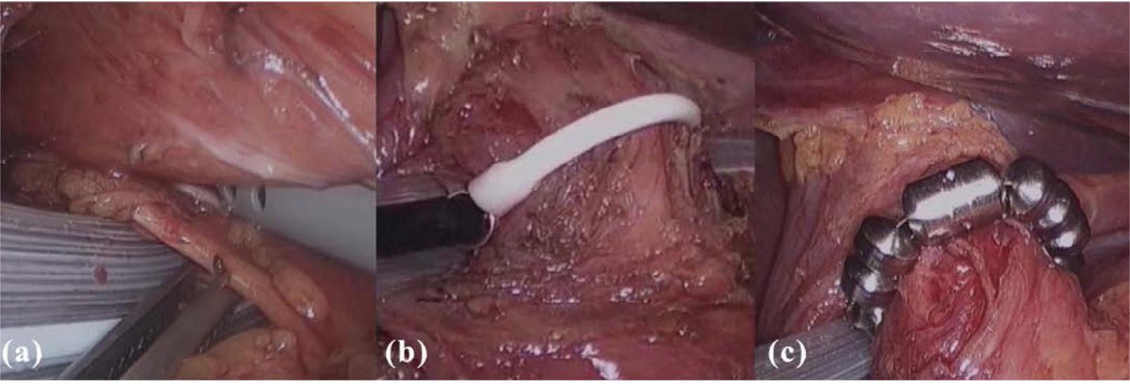 Tunneling between the posterior vagus nerve and the esophageal wall (a), the sizing device in place to measure the esophageal circumference (b), the LINX device positioned at the gastroesophageal junction (c). Bonavina, L., Saino, G., Lipham, J. C., & DeMeester, T. R. (2013). LINX® Reflux Management System in chronic gastroesophageal reflux: A novel effective technology for restoring the natural barrier to reflux. Therapeutic Advances in Gastroenterology, 6(4), 261–268.