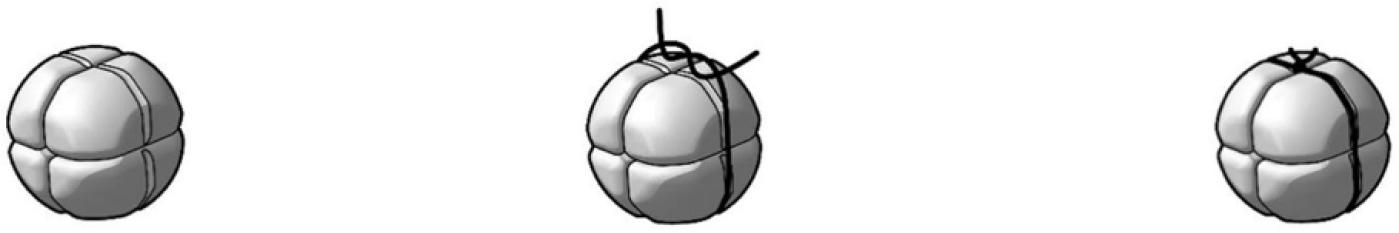 RefluxStop™ implant-illustration without suture, followed by assembly and suture placement. Bjelović, M., Harsányi, L., Altorjay, Á., Kincses, Z., Forsell, P., & Investigators of the RefluxStop™ Clinical Investigation Study Group. (2020). Non-active implantable device treating acid reflux with a new dynamic treatment approach: 1-year results. RefluxStop™ device; a new method in acid reflux surgery obtaining CE mark. BMC Surgery, 20, Article 179