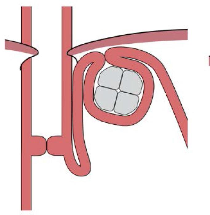 Optimal device placement. Top of the device placed >1 time the device size above the upper edge of the LES. Bjelović, M., Harsányi, L., Altorjay, Á., Kincses, Z., Forsell, P., & Investigators of the RefluxStop™ Clinical Investigation Study Group. (2020). Non-active implantable device treating acid reflux with a new dynamic treatment approach: 1-year results. RefluxStop™ device; a new method in acid reflux surgery obtaining CE mark. BMC Surgery, 20, Article 179