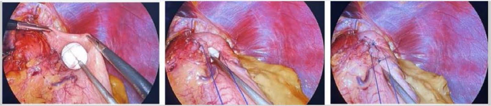 Intraoperative placement and fixation of the RefluxStop™ device. Feka, J., Saad, M., Boyle, N., Paireder, M., Kristo, I., Rieder, E., Asari, R., & Schoppmann, S. F. (2024). Multicentric short term and safety study of ineffective esophageal motility patients treated with RefluxStop device. Scientific Reports.