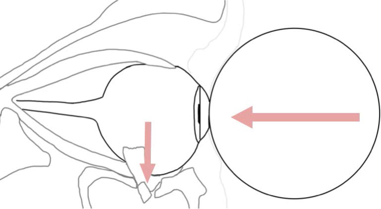 Schematic of the injury mechanism leading to a blow-out fracture of the orbit (own drawing).