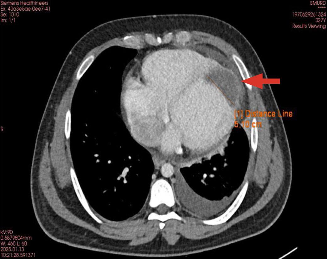 Cardiac computed tomography imaging showing a large thrombus at the left ventricular apex (arrow).