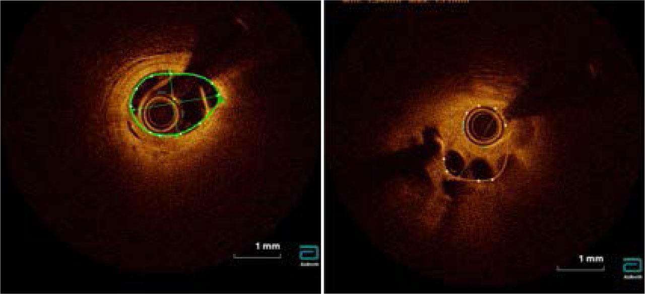 Cardiac optical coherence tomography demonstrating extended thrombotic load with recanalization features and adjacent fibrous plaque without vulnerability signs.
