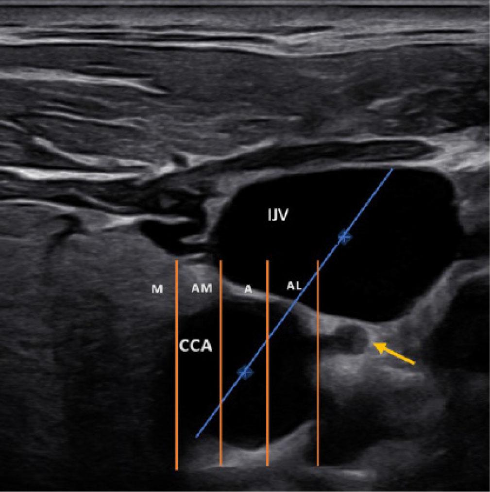 Ultrasound of the neck showing the usual position of the VN (yellow arrow). The VN is located posterior or lateral to the reference axis that joins the centers of the CA and IJV (blue line). A variation in position is defined as the VN being located anterior or medial to the C-I axis. Variations are classified into four types: anterolateral (AL), anteromiddle (A), anteromedial (AM), and medial(M) – based on the relative location of the VN to the carotid artery