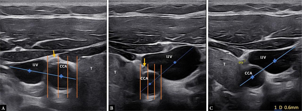 Transverse gray-scale ultrasonographic images of the right (A) and left (B) carotid sheaths in a 40-year-old female, showing the CVN relative to the reference axis (C-I axis). The right VN (yellow arrow) shows anterolateral variation, as demonstrated in image A. The left VN (yellow arrow) shows anteromedial variation, as demonstrated in image B. Image C shows the shortest distance of 0.6 mm of the left VN from the ipsilateral thyroid lobe (represented by “T”)