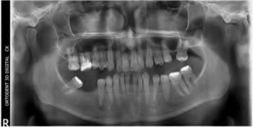 Panoramic radiograph before treatment