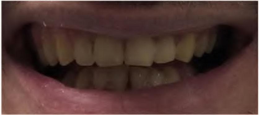 Provisional restorations fabricated at the increased VDO