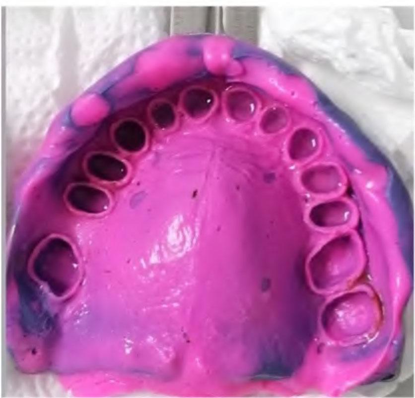 Final impression made in polyvinyl-siloxane using one-step technique