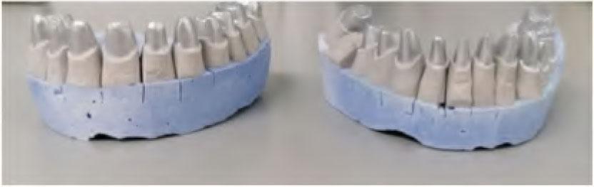 Working maxillary (left) and mandibular (right) casts