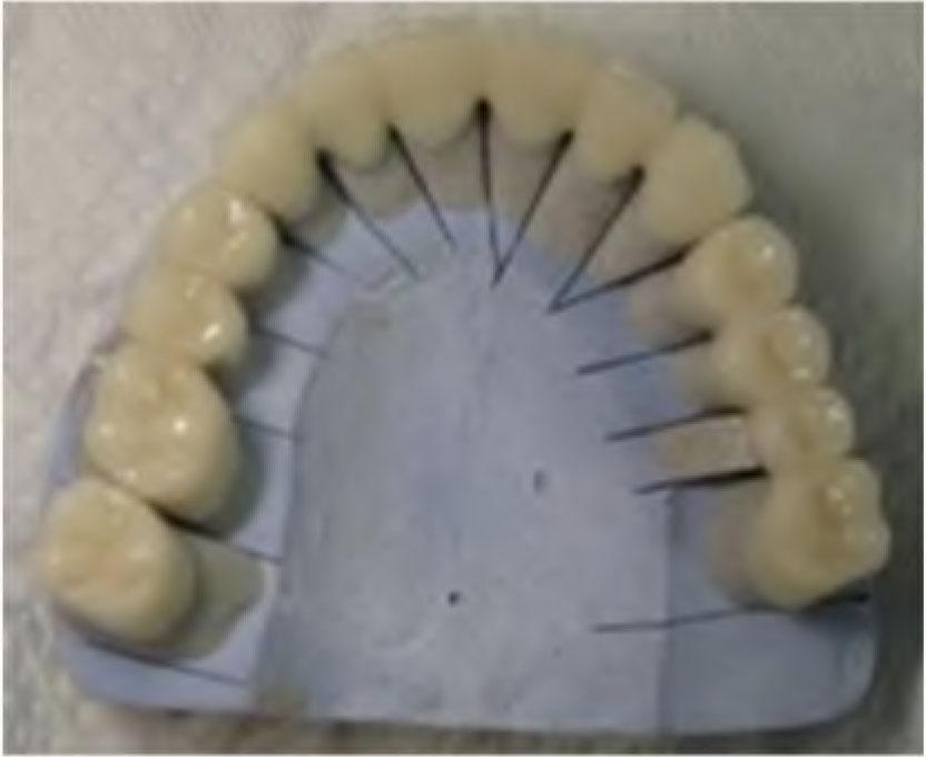 6 units all-ceramic FDP (13–23), 4 units all-ceramic FDP (24–27), 3 units all-ceramic FDP (14–16) and 1 all-ceramic crown on 17 in the maxilla