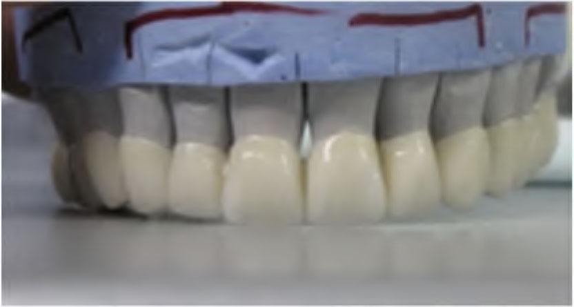 All-ceramic FDP on dental cast model - frontal view