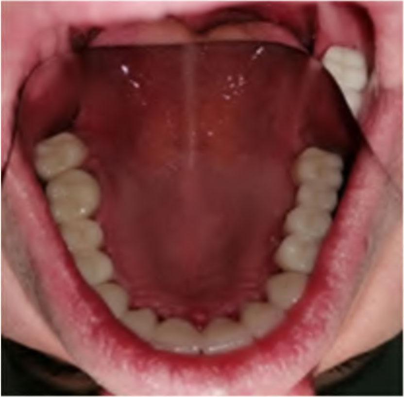 Final result of 6 units all-ceramic FDP (13–23), 4 units all-ceramic FDP (24–27), 3 units all-ceramic FDP (14–16) and 1 all-ceramic crown on 17 after cementation