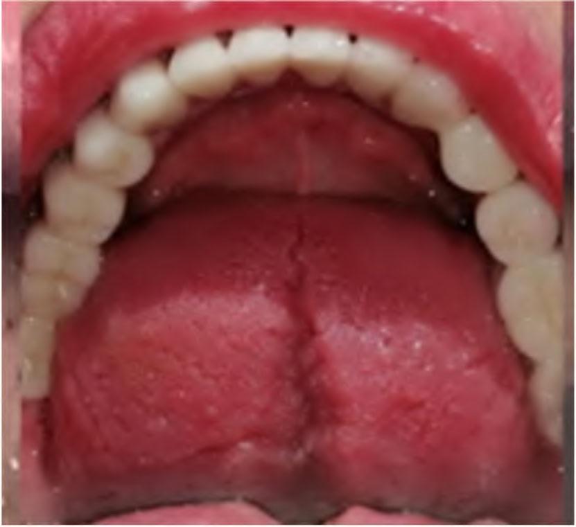 Final result of 7 units all-ceramic FDP (33–44), 3 units all-ceramic FDP (45–47) and 4 units all-ceramic FDP (34–37) after cementation