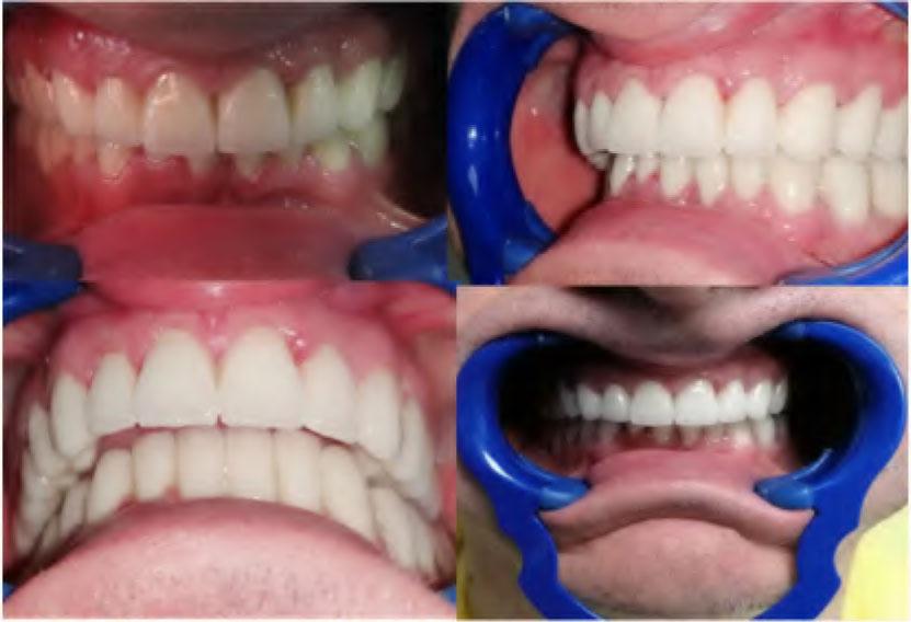 Final result after cementation all-ceramic FDPs in the maxillary and mandibular arches