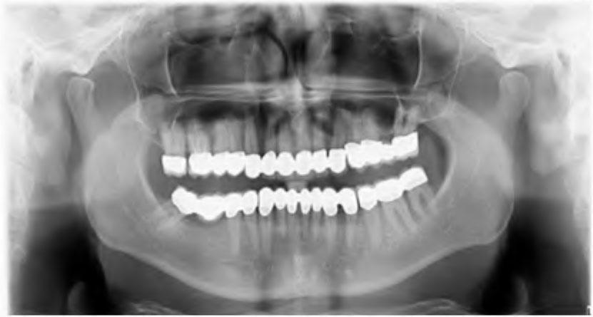 Panoramic radiograph after treatment