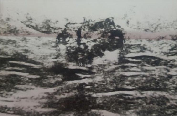 Ultrasound axial plane showing lobulated, heteroechoic tumor mass