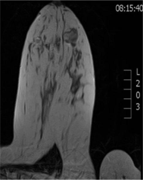 Axial MRI T2W section showing heterointense tumor mass