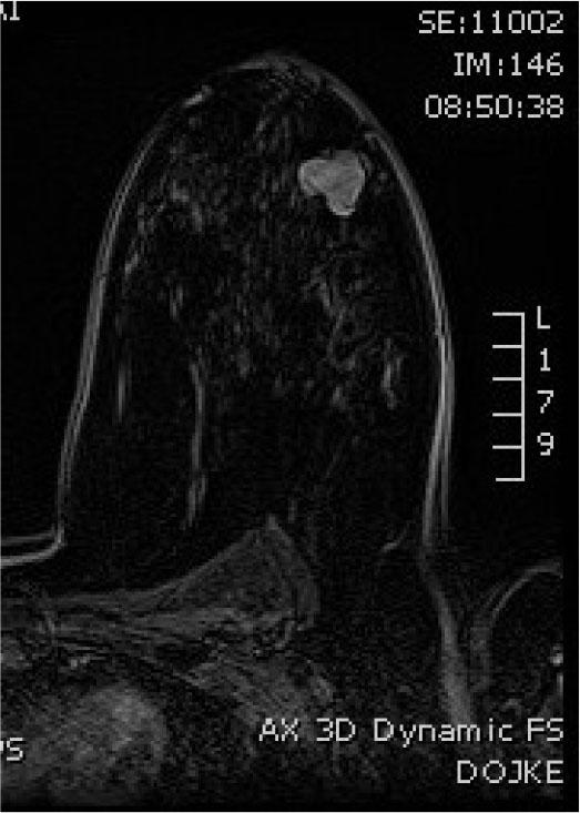 Axial poscontrast T1W section showing hiperintense, lobulated tumor mass