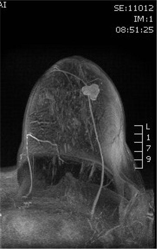 MIP poscontrast reconstruction axial plane showing tumor mass neovascularisation