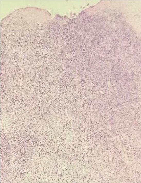 Pathohistological findings showing moderate cellularity, focal moderate atypia, stromal component dominance