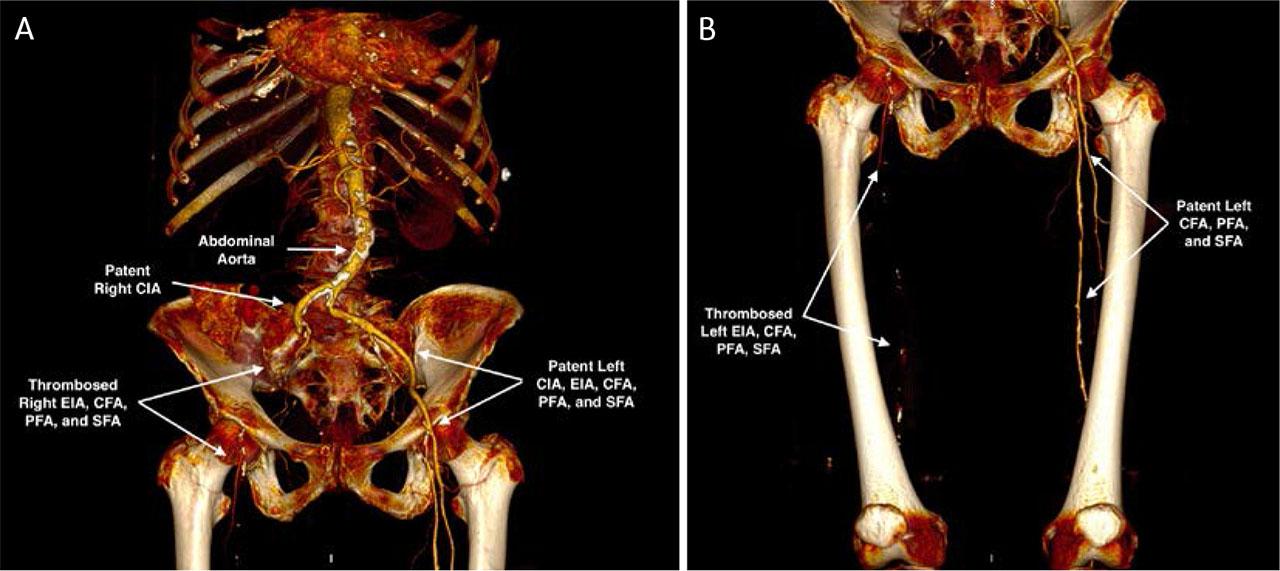 Preoperative CTA with 3D reconstruction showing thrombosis of the right EIA, CFA, PFA, and SFA: suprainguinal (A) and infrainguinal (B) views.