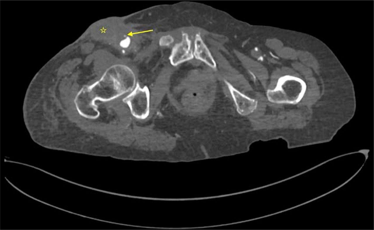 Preoperative CTA demonstrating the pseudoaneurysm with active bleeding (yellow arrow) and the peri-pseudoaneurysmal infection area (asterisk).