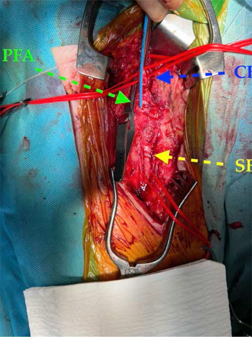 Intraoperative view after removal of the infected patch and preparation of the three femoral arteries for reconstruction.
