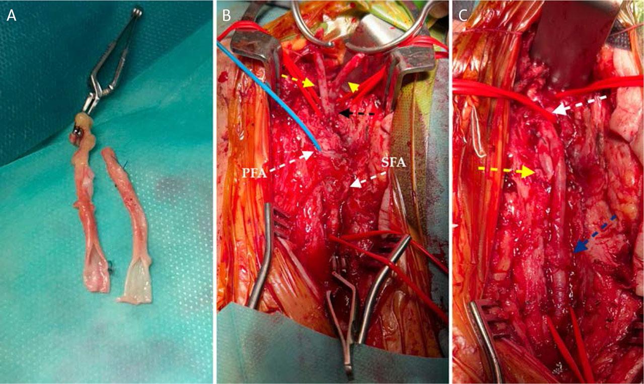 Intraoperative stages of neo-femoral artery reconstruction: creation of a Y-shaped graft from two GSV segments (A); proximal anastomosis with the CFA (B); and final appearance of the reconstruction (C).
