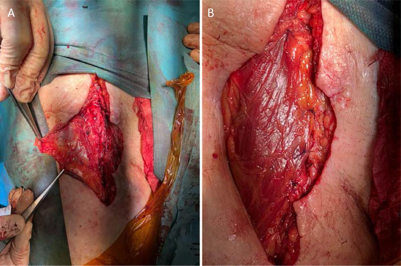 Coverage of the neo-femoral artery using a proximal sartorius muscle flap: flap preparation (A) and final appearance after coverage (B).