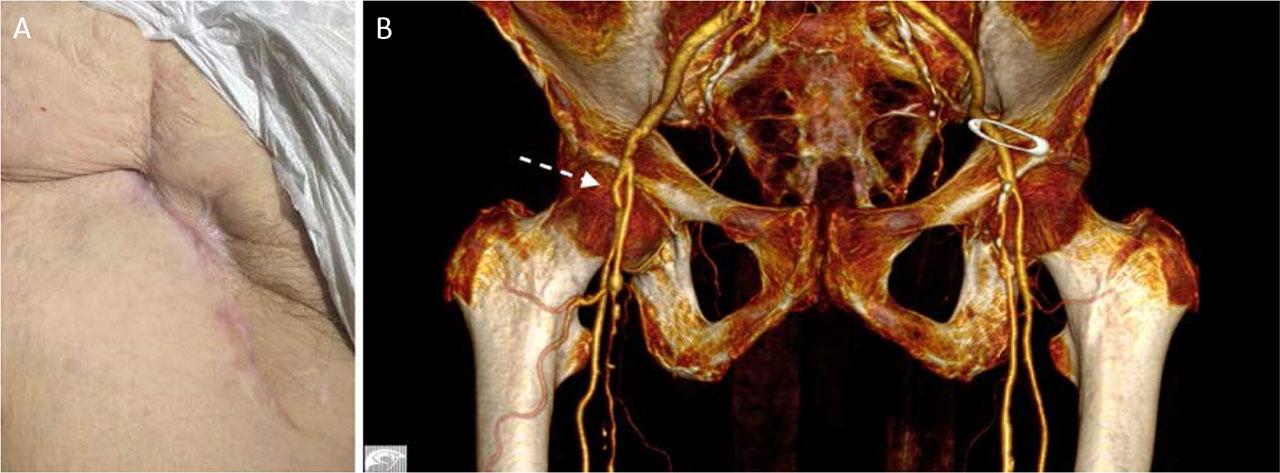 Clinical appearance (A) and 3D CTA reconstruction (B) 1 month after surgery.